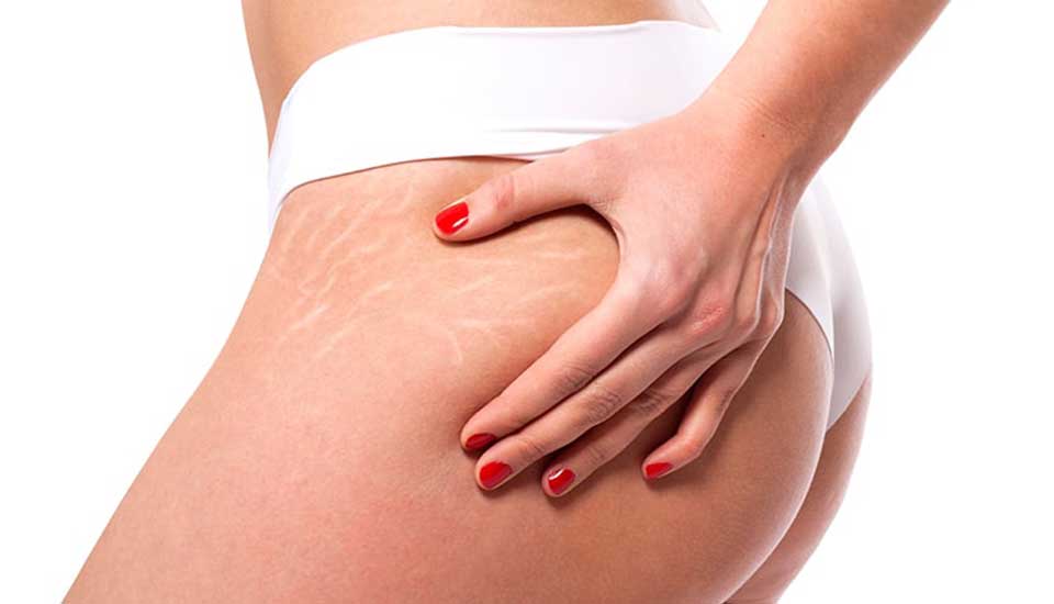 Stretch Mark Treatment